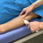 電子温灸器で手三里に施灸している様子