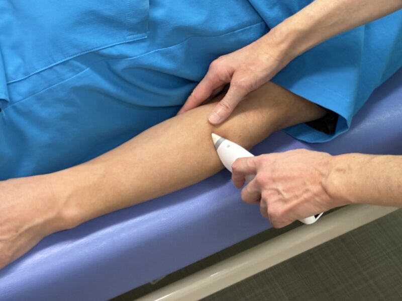 電子温灸器で手三里に施灸している様子